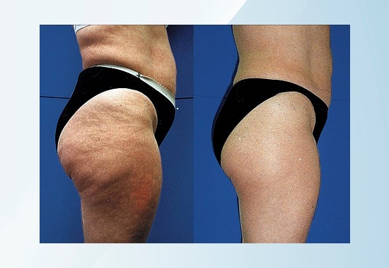 Cellulite removal, cellulite reduction, skin bulging, cellulite