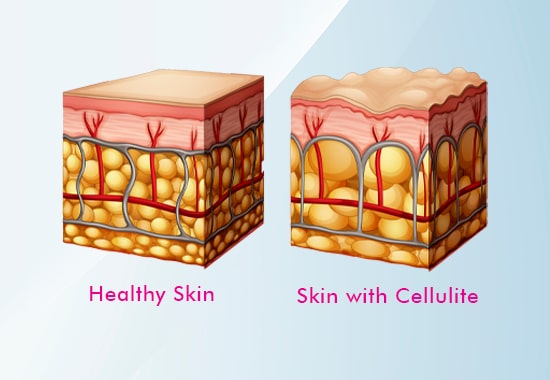 Cellulite removal, cellulite reduction, skin bulging, cellulite