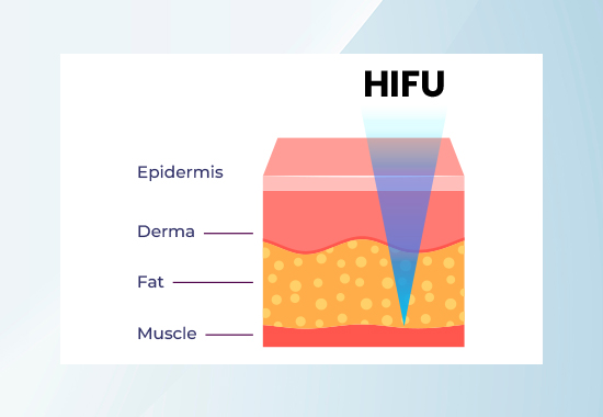 High Intensity Focused Ultrasound, HIFU