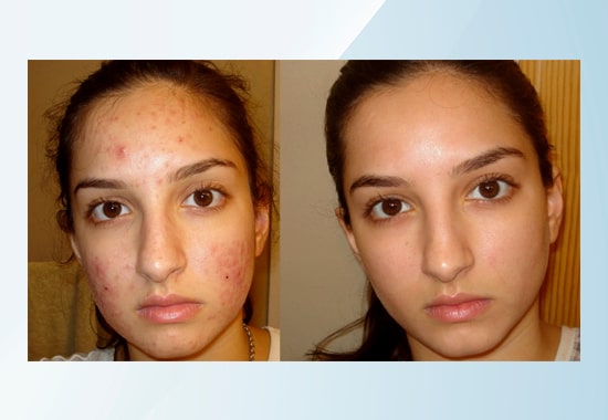 Pimples, Scars, blackheads, whiteheads treatment clinics, centers in mumbai